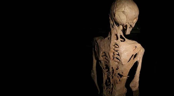 Horrible Rare Genetic Disease Turns Humans to Statues